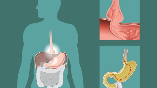 Hernia del Hiato: molesta y peligrosa, entérate de los detalles